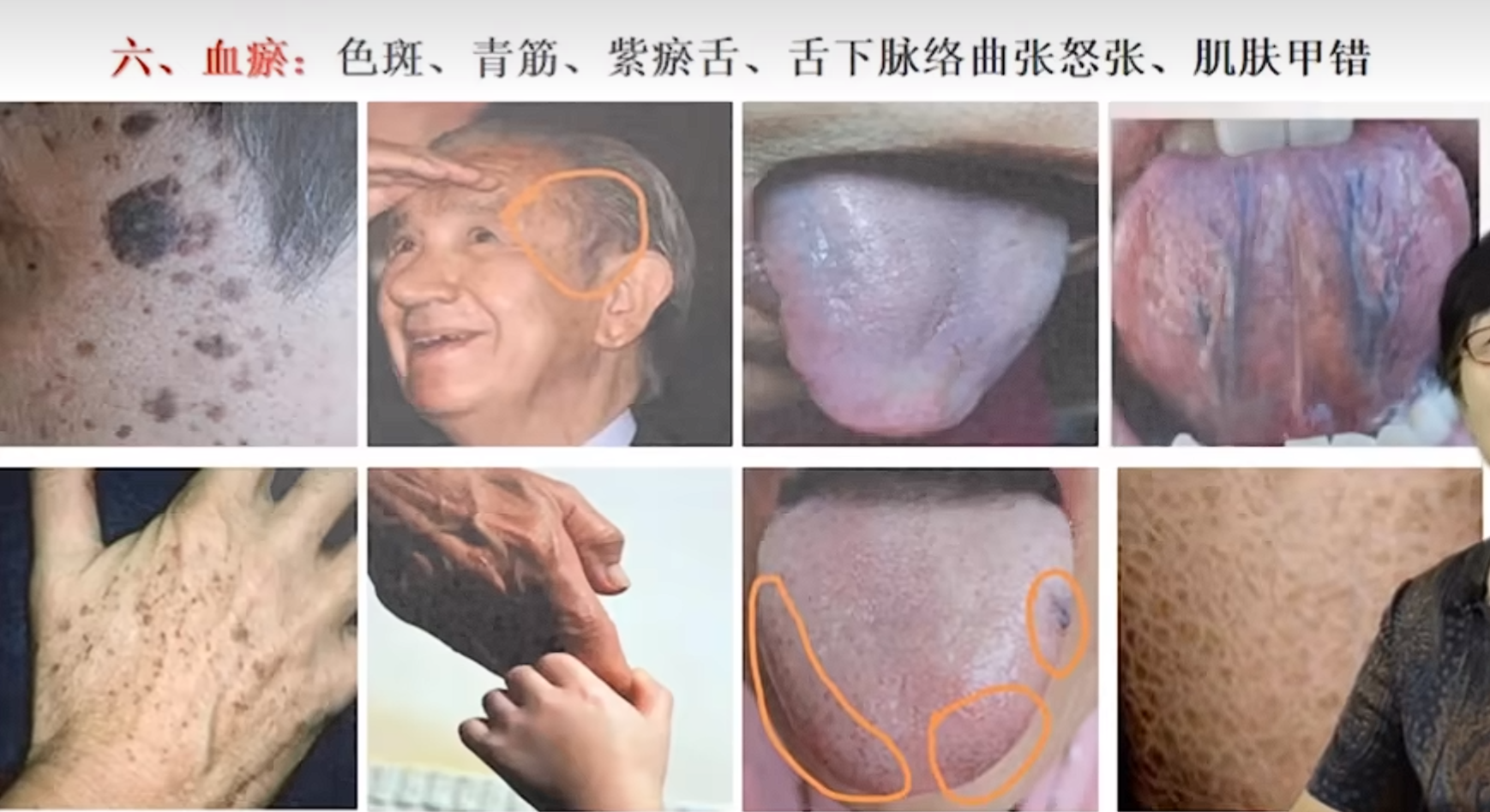 血瘀图